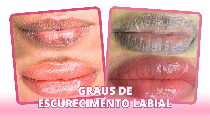 GRAUS DE ESCURECIMENTO LABIAL